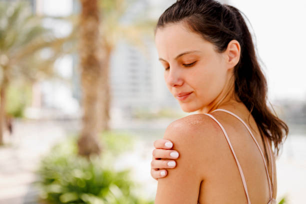 10 natural home remedies that you can use to ease the pain of sunburn 