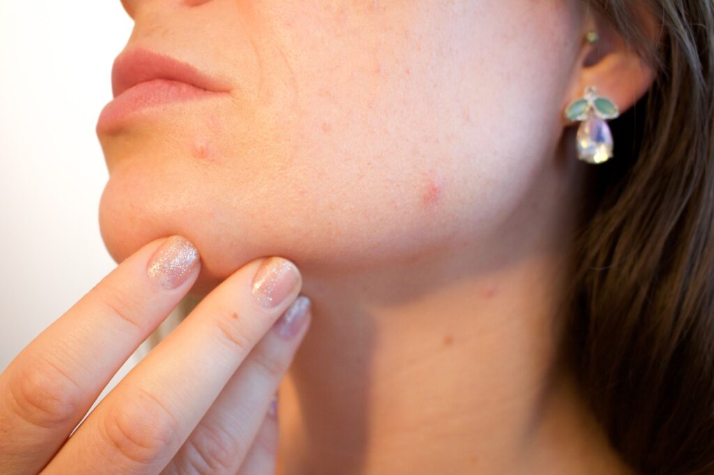 15 Easy and Natural Ways to Get Rid of Acne Here are some tips that have helped hundreds of people suffering from acne.  