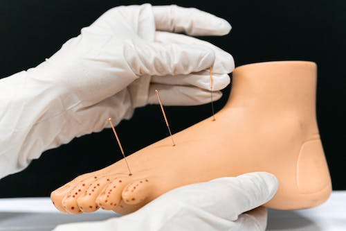 The best part about acupuncture is that there are no harmful side effects